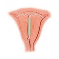 Contraceptive Device